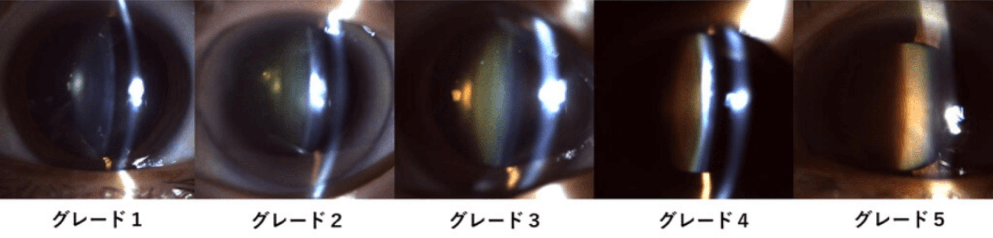 核硬化グレーディング